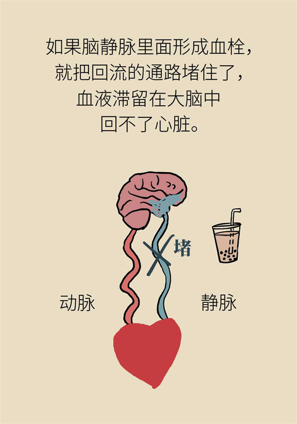脑静脉血管栓塞使人晕厥，只因奶茶喝得太频繁？